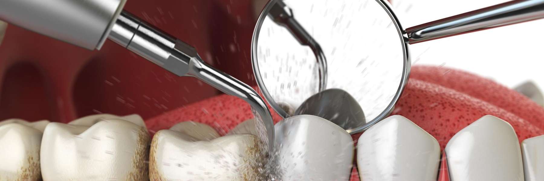 close up of dental tool on tooth | dentist oakbrook terrace