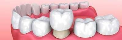 dental crown diagram in oakbrook terrace il